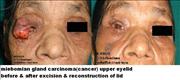 Before After Pictures,Delhi,skin cancer, eyelid cancer